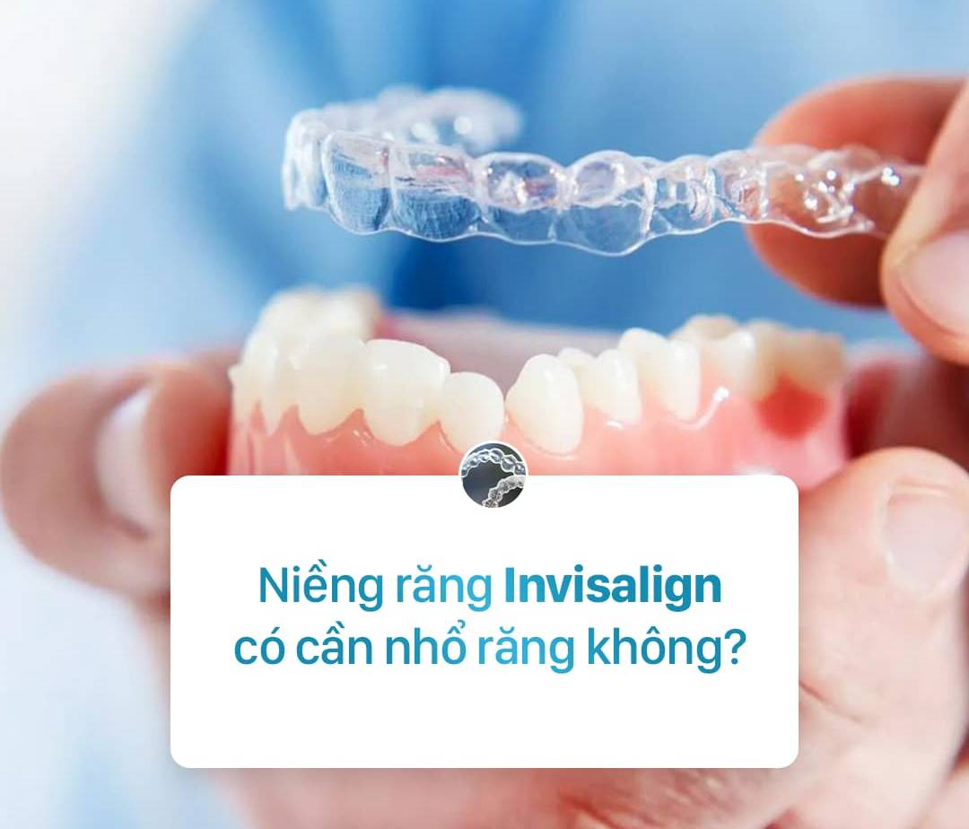  Niềng răng Invisalign có cần thiết phải nhổ răng không? 
