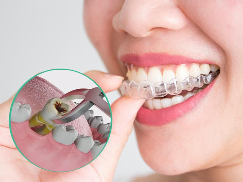 Nhổ răng trước khi niềng răng Invisalign có thể là cần thiết và tốt cho sức khỏe răng miệng